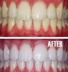 teeth whitening dentists in brisbane