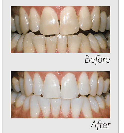 healthy teeth dental brisbane tooth whitening